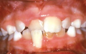 Crossbite-of-Front-Teeth